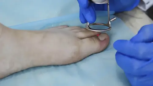 αφαίρεση ενσφηνωμένου νυχιού