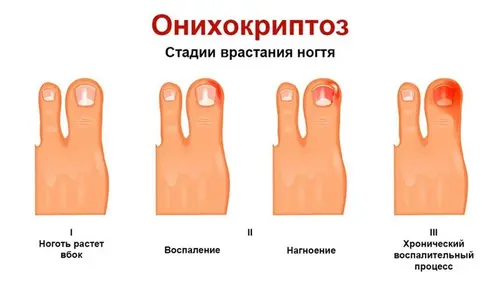 Στάδια ονυχοκρύπωσης της ανάπτυξης των νυχιών